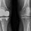 Total knee replacement – what you can expect in three months?